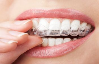 Clear Aligner Trays